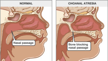 Choanal-atresia