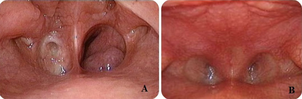 Choanal Atresia Causes Symptoms Diagnosis And Treatment 0224