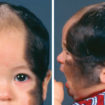 Congenital melanocytic nevus