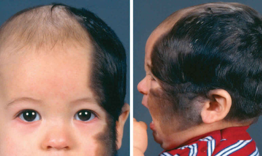 Congenital melanocytic nevus