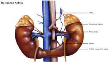 Horseshoe-kidney