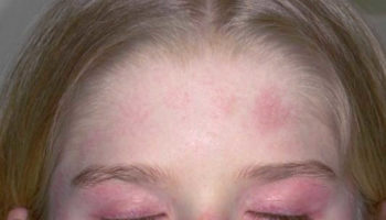 Juvenile dermatomyositis