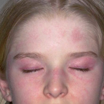 Juvenile dermatomyositis