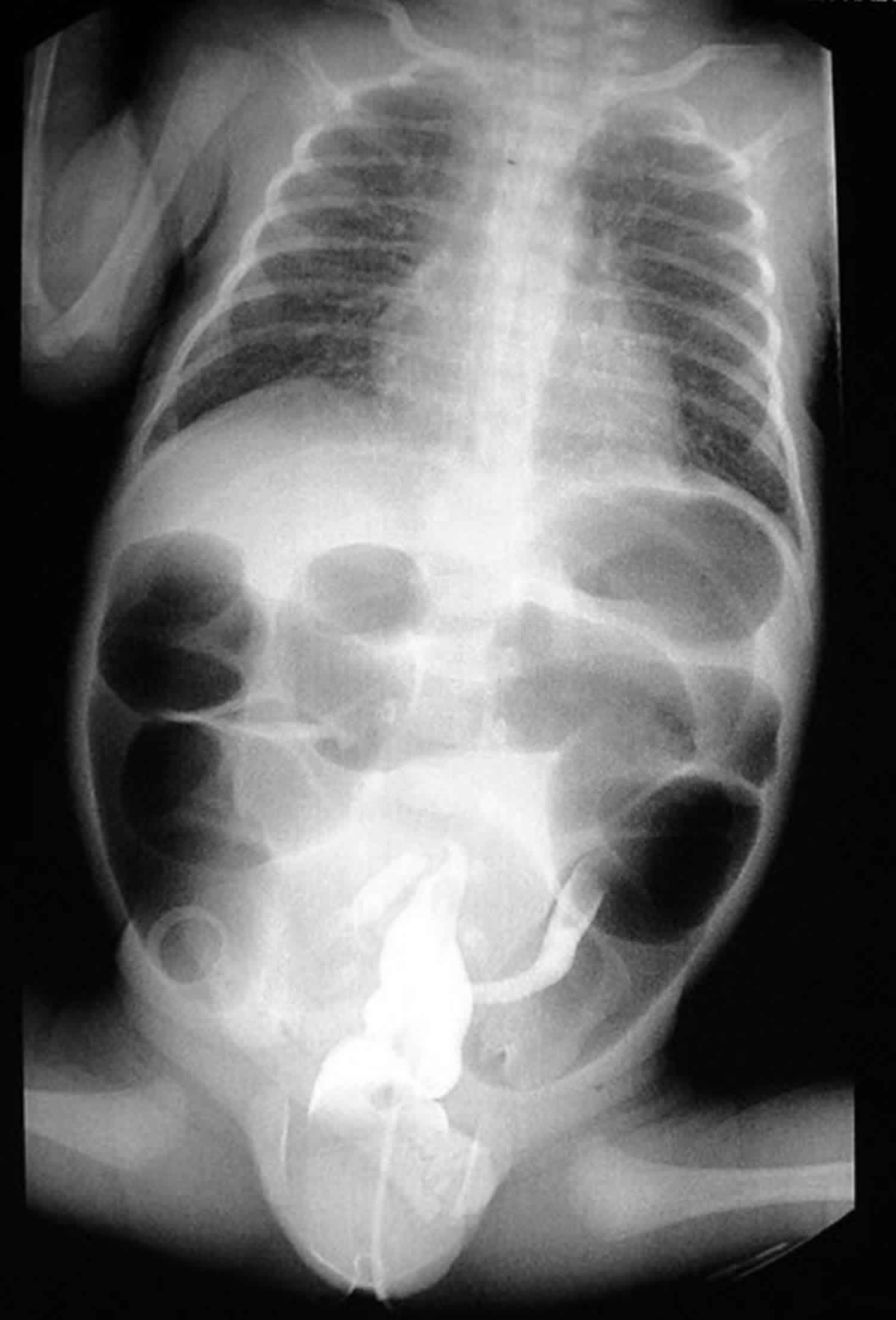 Meconium ileus abdominal X-ray