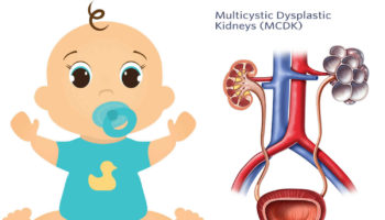 Multicystic-dysplastic-kidney