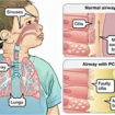 Primary-ciliary-dyskinesia