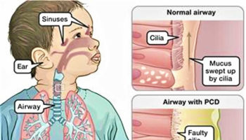 Primary-ciliary-dyskinesia