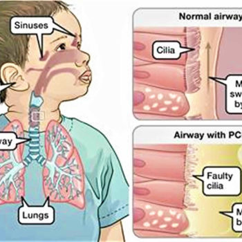 Primary-ciliary-dyskinesia