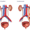 Ureterocele