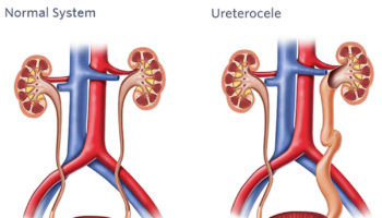 Ureterocele