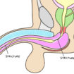 Urethral-stricture