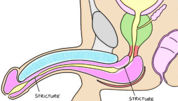 Urethral-stricture