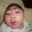 anencephaly