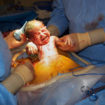 cesarean-section