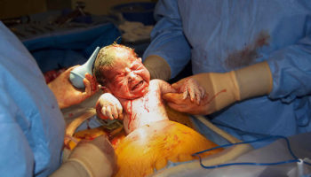 cesarean-section