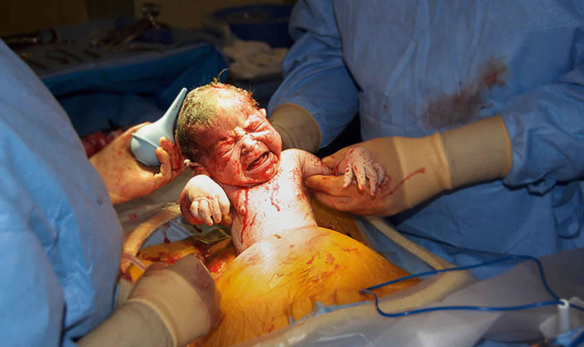 cesarean-section