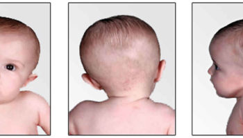 congenital torticollis