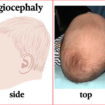 deformational plagiocephaly