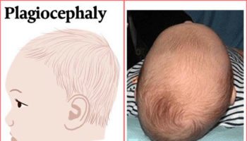 deformational plagiocephaly