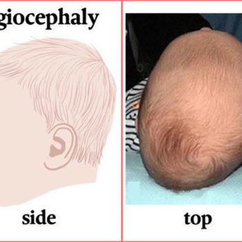 deformational plagiocephaly