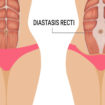 diastasis recti