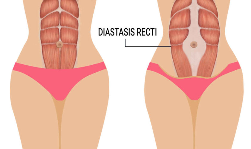 diastasis recti