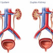 duplex kidney