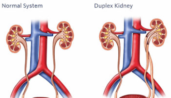 duplex kidney