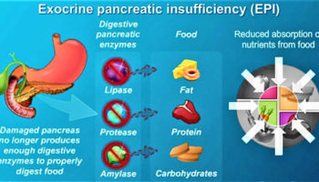 exocrine-pancreatic-insufficiency