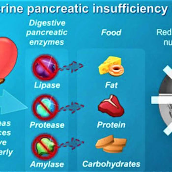 exocrine-pancreatic-insufficiency