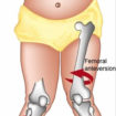 femoral anteversion