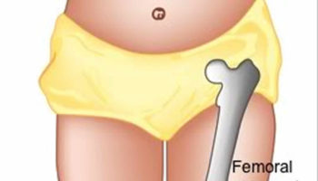 femoral anteversion