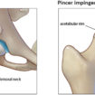 femoroacetabular impingement