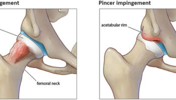 femoroacetabular impingement