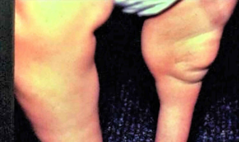 fibular hemimelia