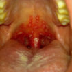 gingivostomatitis