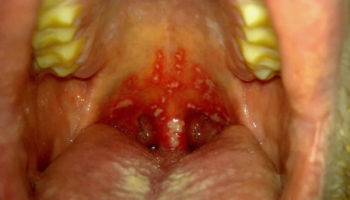 gingivostomatitis