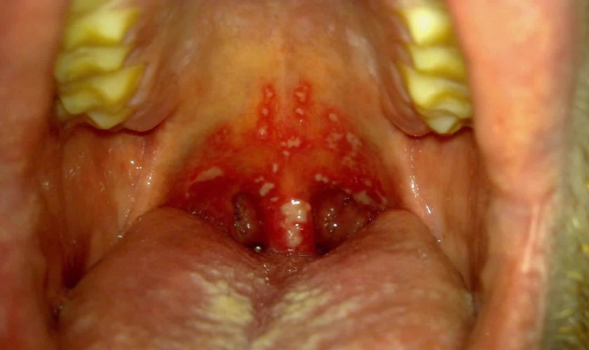 gingivostomatitis