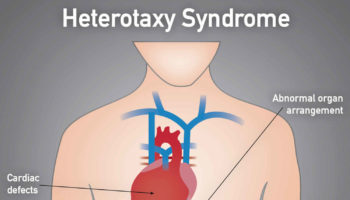 heterotaxy syndrome