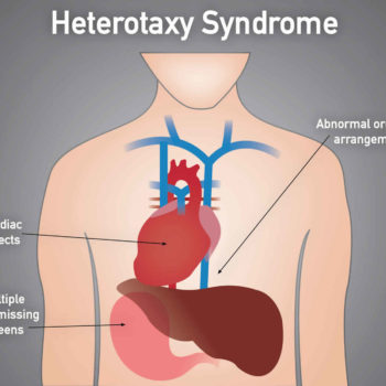 heterotaxy syndrome