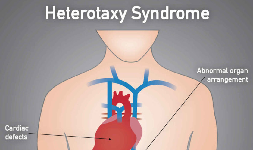 heterotaxy syndrome