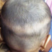 infant hair loss