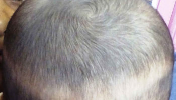 infant hair loss