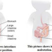 intestinal malrotation