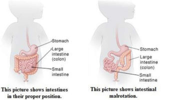 intestinal malrotation