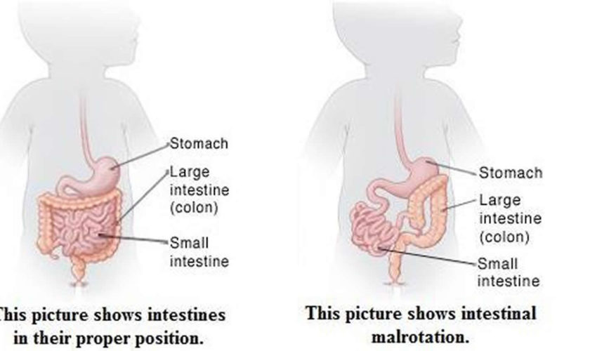 intestinal malrotation