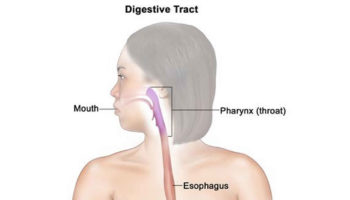 juvenile polyposis syndrome