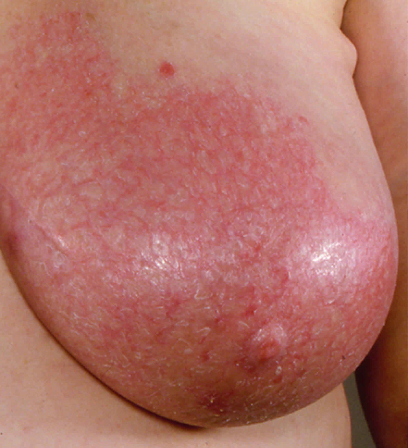 аллергия на груди у беременной фото 24