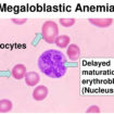 megaloblastic-anemia