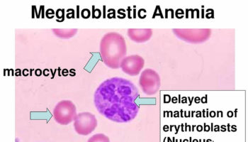 megaloblastic-anemia